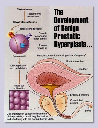 testosterone and prostatitis)